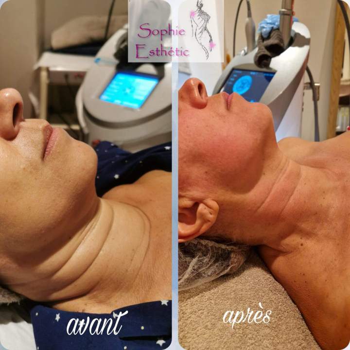 Avant/après soins cutanés Sèvres